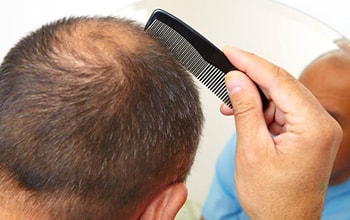 آیا کاشت مو برای افرادی که به صورت موقت دچار ریزش مو شده اند امکان پذیر است ؟